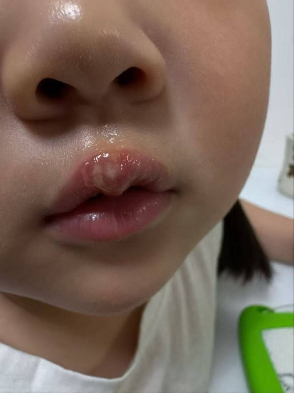 Xuzhou Kindergarten Teacher Accused of Burning Child