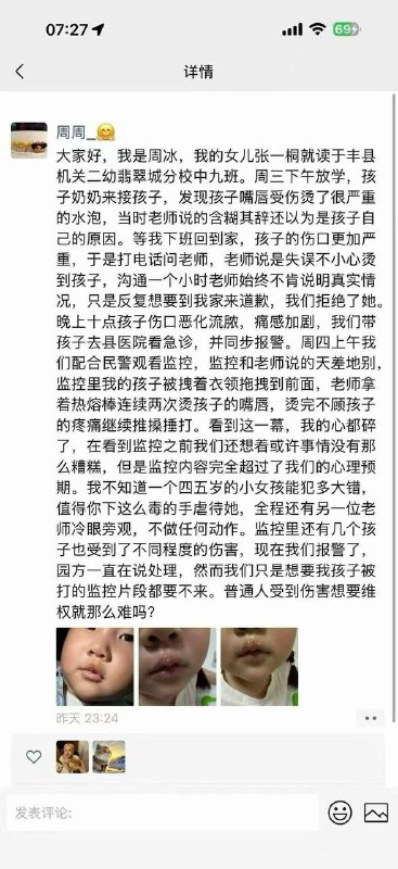Xuzhou Kindergarten Teacher Accused of Burning Child